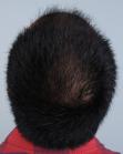 Before Hair Transplant&nbsp;Front
